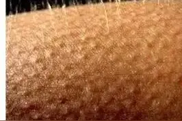 “鸡皮”粗糙爱发红，形成颗粒千万不能抠！图片