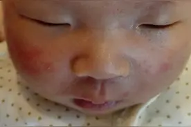 宝宝脸上头皮起了有白脓包的疹子怎么护理？图片