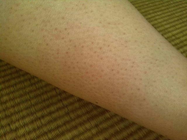 怎样可以去鸡皮疙瘩皮肤