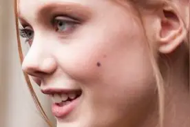 激光点痣后要注意什么 常见的点痣方法图片