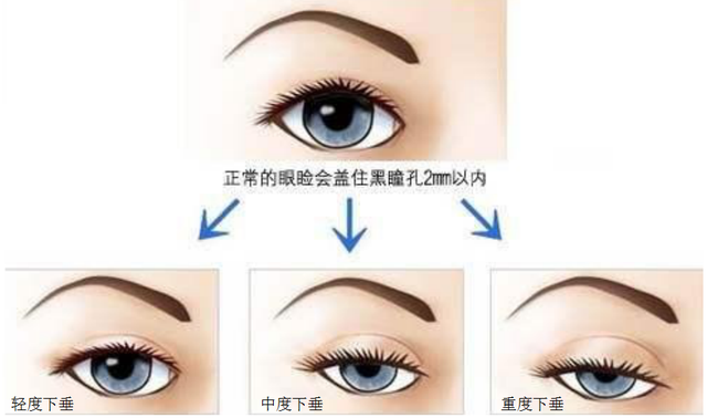 眼裂是什么(大眼睛一定健康吗什么是眼睛闭不拢快照