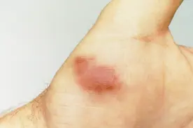 这肿瘤基本上只长在艾滋病人身上！大家要注意！视频封面