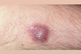 艾滋病常见肿瘤—卡波氏肉瘤