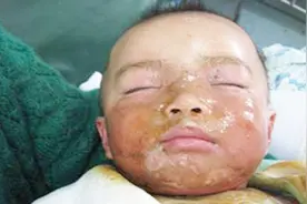 火锅店服务员脚滑，滚烫火锅汤泼向孩子，宝宝被严重烫伤！视频封面