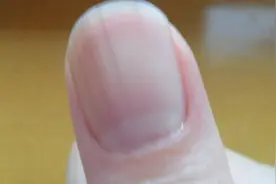 指甲上有竖纹，不仅仅是指甲缺少营养，还可能是这些原因