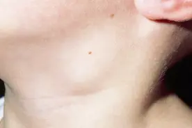 艾滋病病人发生淋巴结肿大该怎么办，专家给你支个招！