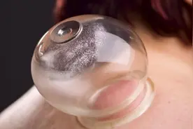 火罐有几种 拔罐器与拔火罐方法如何选择图片