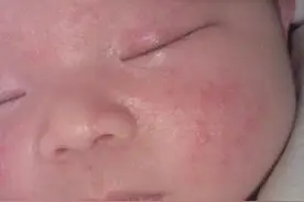 宝宝一夜之间脸部长满红疙瘩，知道真相后宝妈心里一阵慌凉！图片