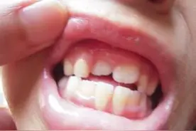 喂奶竟让宝宝变成了龅牙！99%的父母不知道如何正确使用奶嘴图片