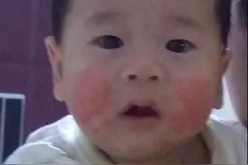 宝宝脸上长奶癣、湿疹怎么办？简单根治好方法图片