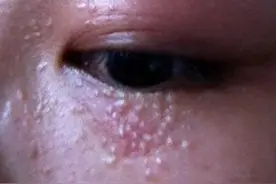你的眼部为什么会长脂肪粒？如何祛除眼部脂肪粒图片