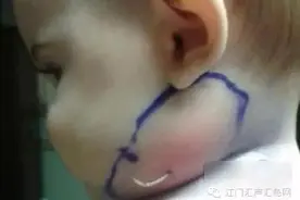 女婴无故发烧，隔天脸上竟长出羽毛！图片