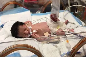 那个因肠子露出体外早产，被保鲜膜救活的男孩长大啦，生日照超帅视频封面