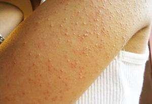 膀子上白色的鸡皮疙瘩