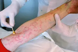 艾滋病皮疹是什么，是什么时期会出现的视频封面