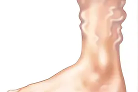 脉管炎是一种疼痛感比较明显的疾病，日常护理需要注意止疼！视频封面