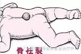 宝宝出生记得看看背部 警惕脊柱裂图片