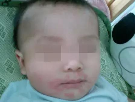 宝宝过敏怎么办？教你几个妙招，让宝宝不再遭罪！