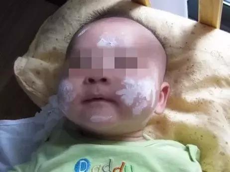 宝宝过敏怎么办？教你几个妙招，让宝宝不再遭罪！
