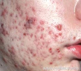毛周角化用强脉冲光