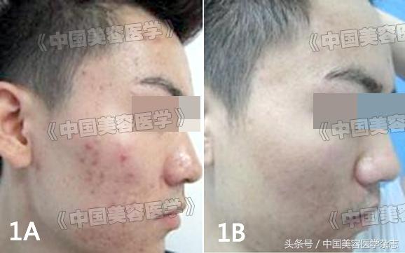 毛周角化用强脉冲光
