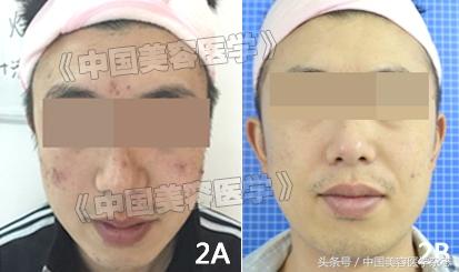 毛周角化用强脉冲光