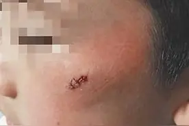 小学生被老师用笔划脸2下缝3针 皮开肉绽只因午睡没睡着图片