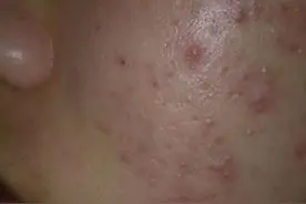 痘痘冒出来怎么办？只要在睡前涂抹大蒜，隔天会带给你惊奇的效果图片