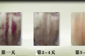 你适合刮痧吗？刮痧的好处？据说这是最通俗易懂的版本视频封面