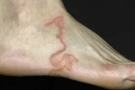 旅游回来发现脚上长了奇怪的东西，检查后发现脚里居然有寄生虫图片