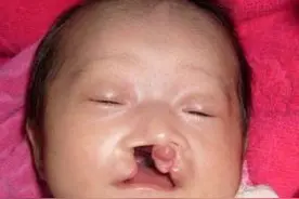 5个月查出胎宝宝有兔唇，要还是不要？图片