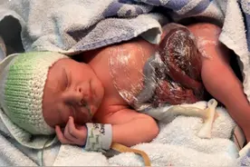 女婴出生患怪病肠子露体外，医生用一张保鲜膜保住性命！(图)图片