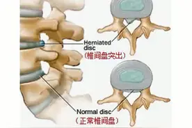 1杯白酒加农村的草，颈椎“富贵包”一治一个好，颈椎不好的快试视频封面