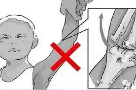 如何处理宝宝胳膊脱臼图片