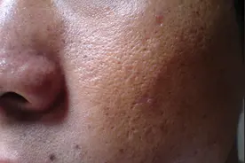 毛孔粗大怎么办？从日常护理做起!图片
