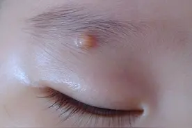 宝宝眉毛附近长疙瘩，家长们要注意了图片