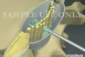 硬膜外及脊椎麻醉「3D动画」