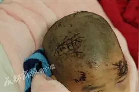 看着都疼！德阳5岁男童被藏獒2次扑倒撕咬 缝了38针图片