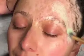 19岁女孩“烧伤”面目全非，学会化妆后，每天坚持，现在成了这样视频封面