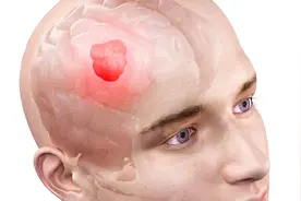 这种肿瘤发病快，生存期不足两年，初期症状头疼恶心