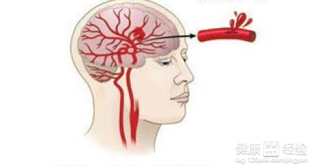 鍙堝埌鍐锛岃剳鍑鸿楂樺彂浜嗭紝浣犵煡閬撳浣曢闃插悧锛? onerror=