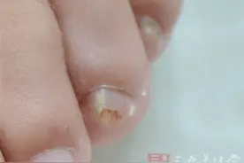 脚趾甲发白怎么回事图片