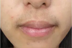 3次冰点脱唇毛后，小胡子没有了图片