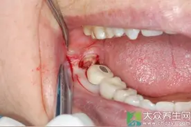 智齿要拔吗这种智齿非拔不可图片