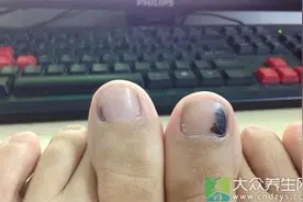 指甲盖中惊现此物绝对是肿瘤图片