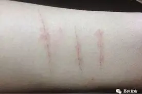 初三女生刀划手臂！广济医院82天接诊2000多例少儿抑郁症，孩子们怎么啦？图片