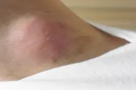腋下长了个小疙瘩是怎么回事？专家告诉你视频封面