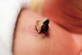 新生儿脐带脱落时间及护理重点！图片