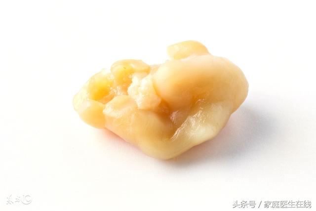 扁桃体角化去除
