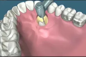 牙齿长到了天花板上？你没见过的神操作视频封面
